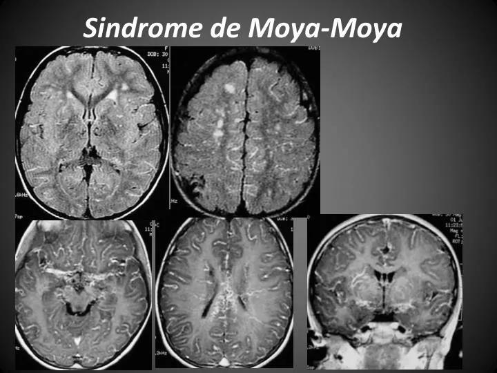 sindrome de moya moya