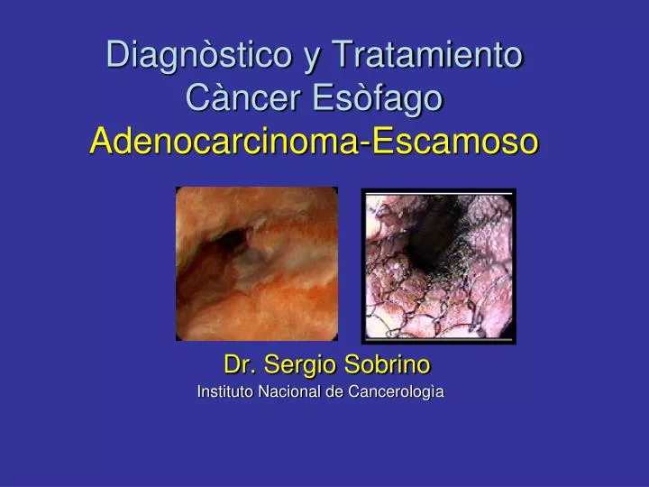 diagn stico y tratamiento c ncer es fago adenocarcinoma escamoso