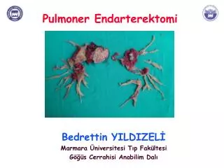 pulmoner endarterektomi