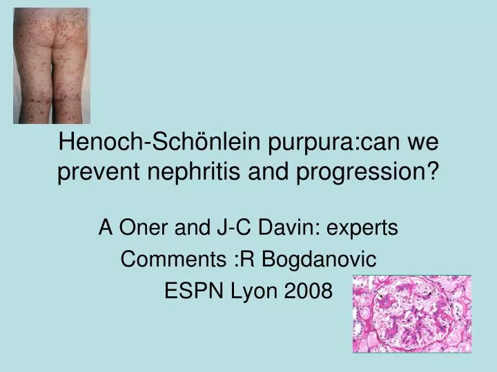 henoch sch nlein purpura can we prevent nephritis and progression