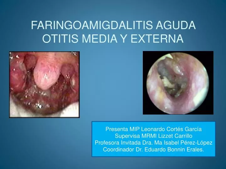 faringoamigdalitis aguda otitis media y externa