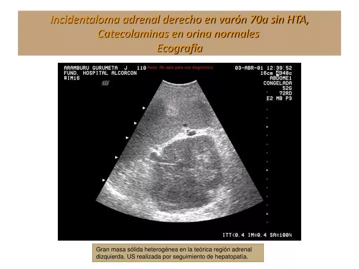 incidentaloma adrenal derecho en var n 70a sin hta catecolaminas en orina normales ecograf a