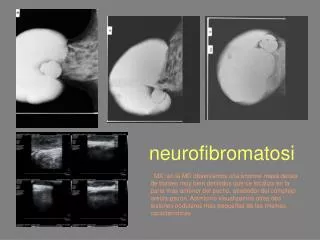 neurofibromatosi