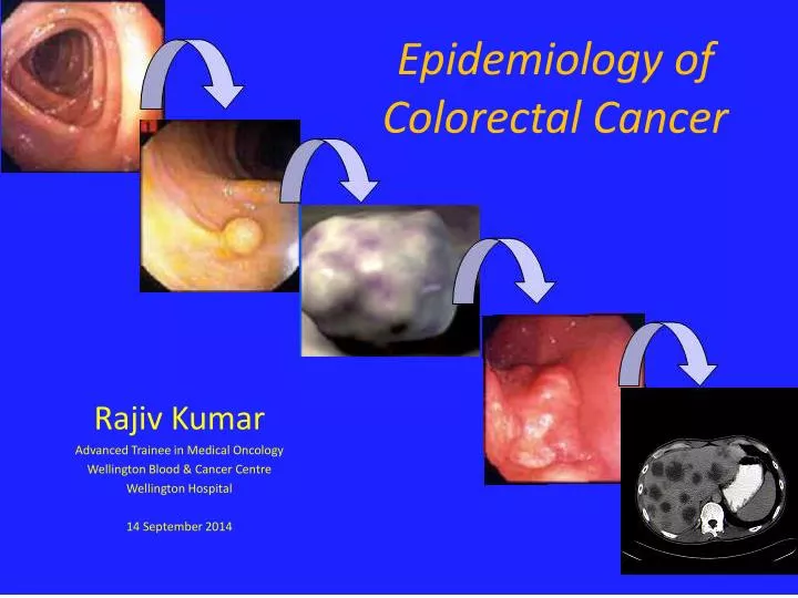 epidemiology of colorectal cancer