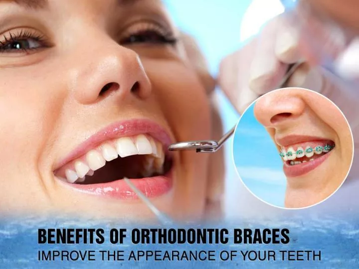 benefits of orthodontic braces improve the appearance of your teeth