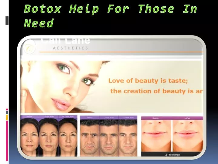 botox help for those in need