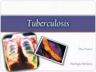 tuberculosis