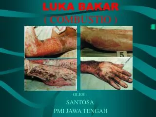 luka bakar combustio