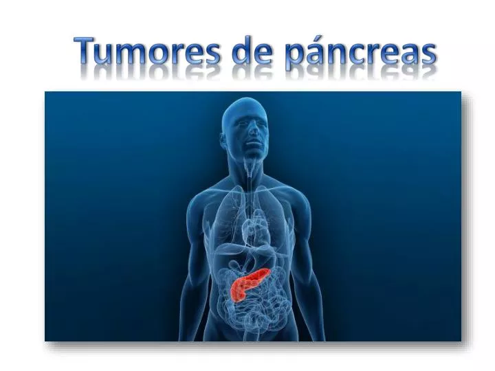 tumores de p ncreas