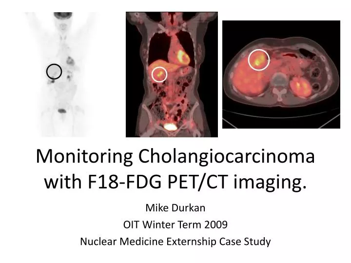 monitoring cholangiocarcinoma with f18 fdg pet ct imaging
