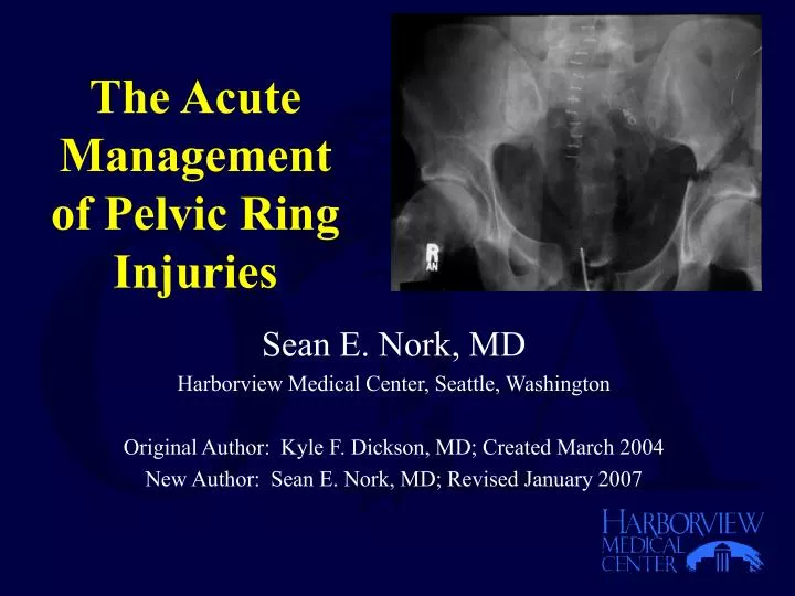 the acute management of pelvic ring injuries
