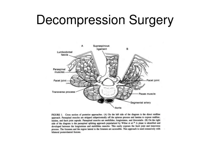 decompression surgery