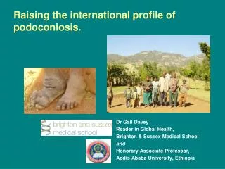 Raising the international profile of podoconiosis.