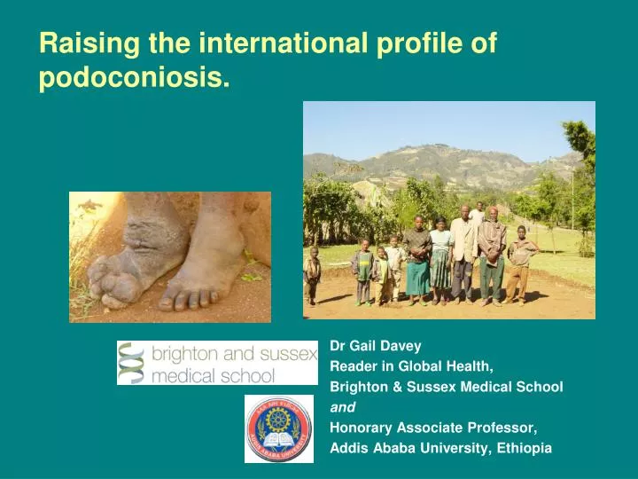 raising the international profile of podoconiosis