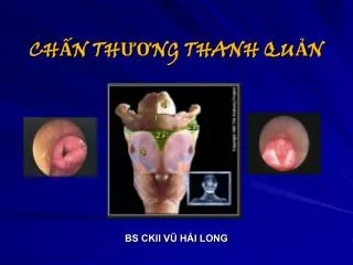 ch n th ng thanh qu n