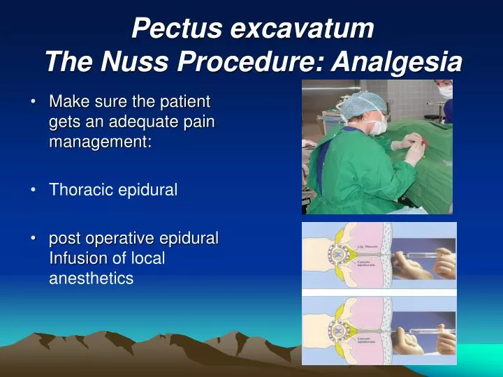 pectus excavatum the nuss procedure analgesia