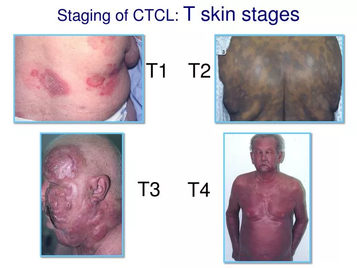 staging of ctcl t skin stages