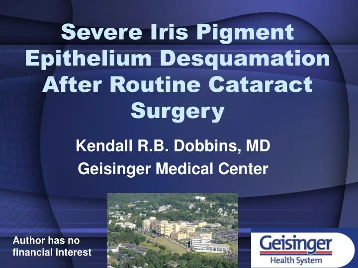 severe iris pigment epithelium desquamation after routine cataract surgery