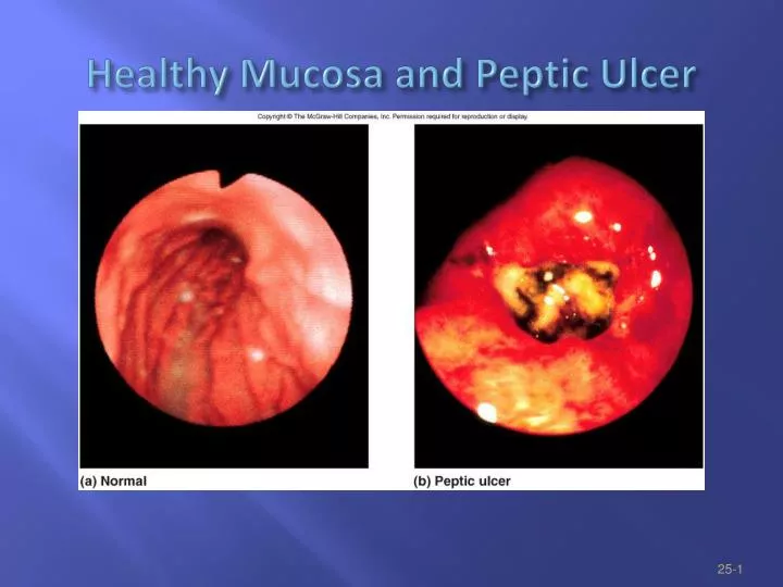 healthy mucosa and peptic ulcer