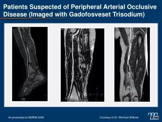 Patients Suspected of Peripheral Arterial Occlusive Disease (Imaged with Gadofosveset Trisodium)