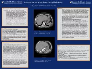 Intermittent Ischemia due to an Unlikely Toxin