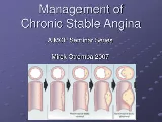 Management of Chronic Stable Angina