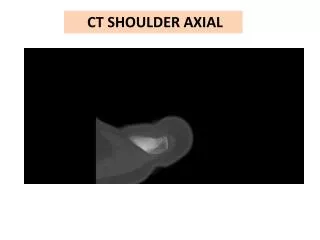 CT SHOULDER AXIAL