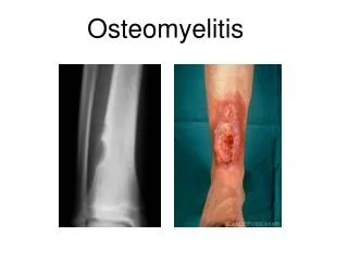 osteomyelitis