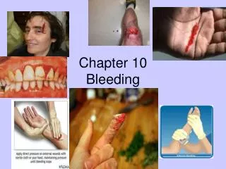 Chapter 10 Bleeding