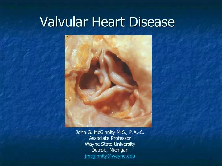 valvular heart disease