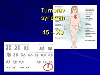 turner v syndrom 45 x0
