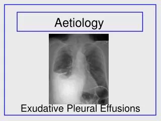 Exudative Pleural Effusions