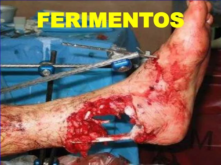 ferimentos