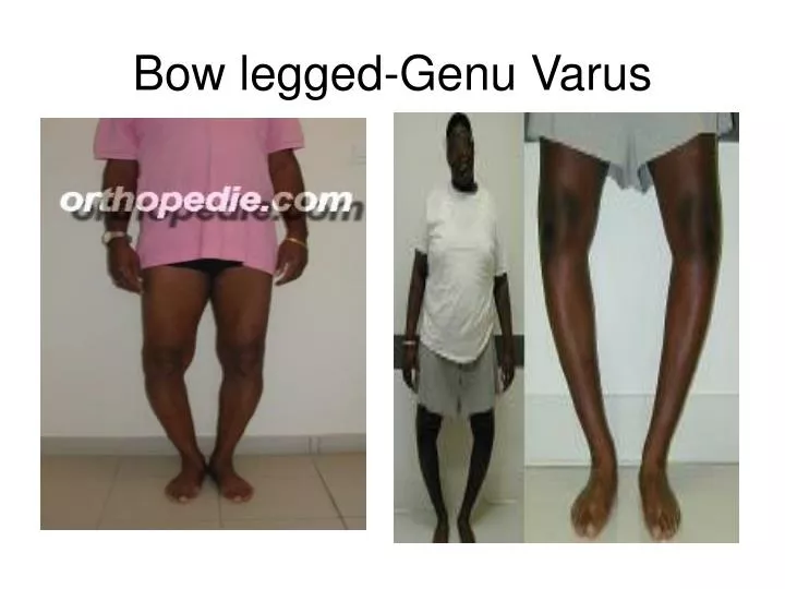 bow legged genu varus