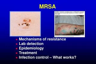 MRSA