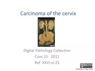 Carcinoma of the cervix