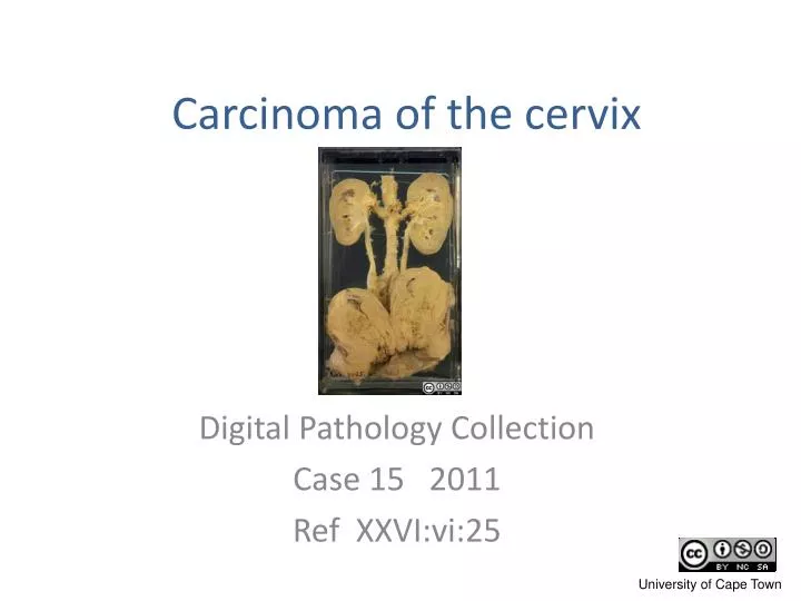 carcinoma of the cervix