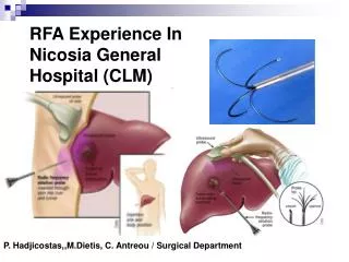 RFA Experience In Nicosia General Hospital (CLM)