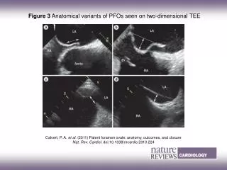 Figure 3 Anatomical variants of PFOs seen on two-dimensional TEE