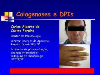colagenoses e dpis