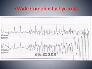 ?Wide Complex Tachycardia