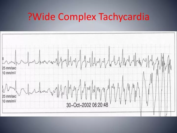 wide complex tachycardia