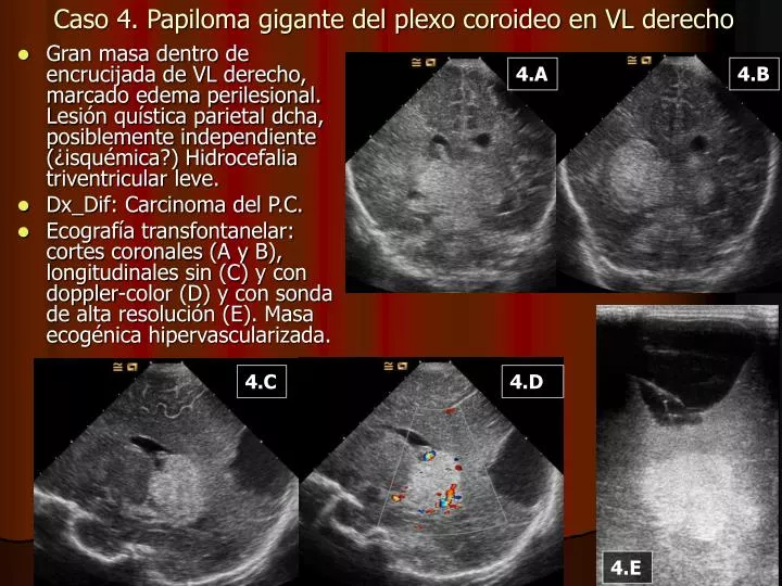 caso 4 papiloma gigante del plexo coroideo en vl derecho