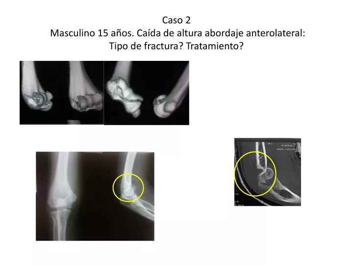 caso 2 masculino 15 a os ca da de altura abordaje anterolateral tipo de fractura tratamiento