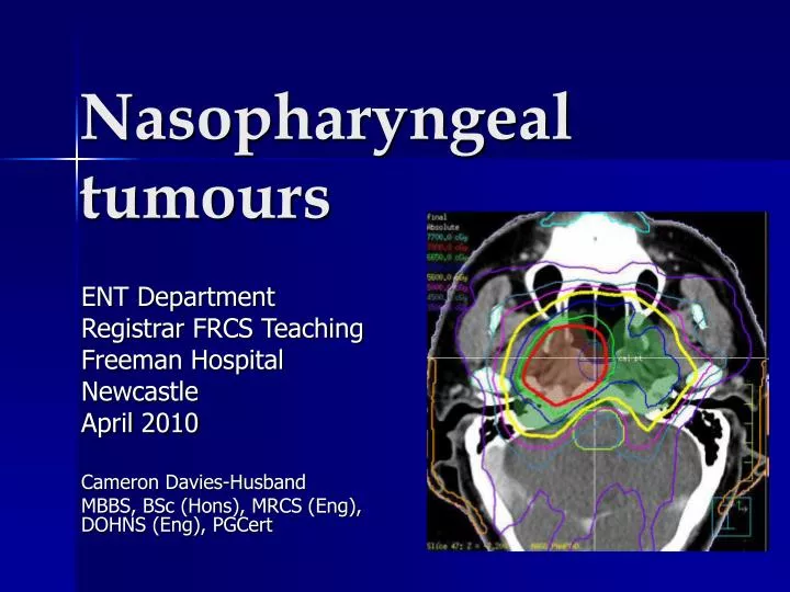 nasopharyngeal tumours