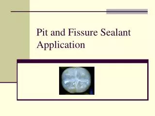 Pit and Fissure Sealant Application