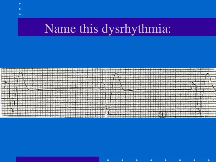name this dysrhythmia