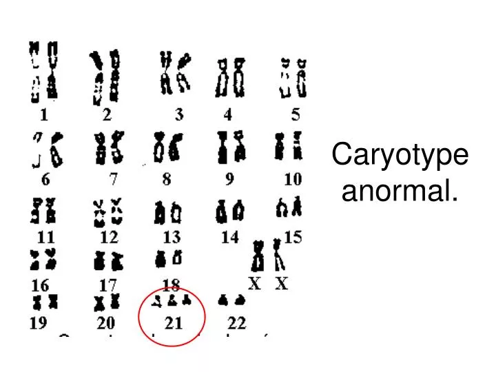 caryotype anormal