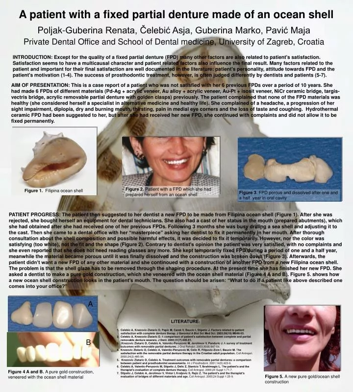 a p atient with a fixed partial denture made of an ocean shell