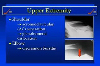 Shoulder acromioclavicular (AC) separation glenohumeral dislocation Elbow olecrannon bursitis